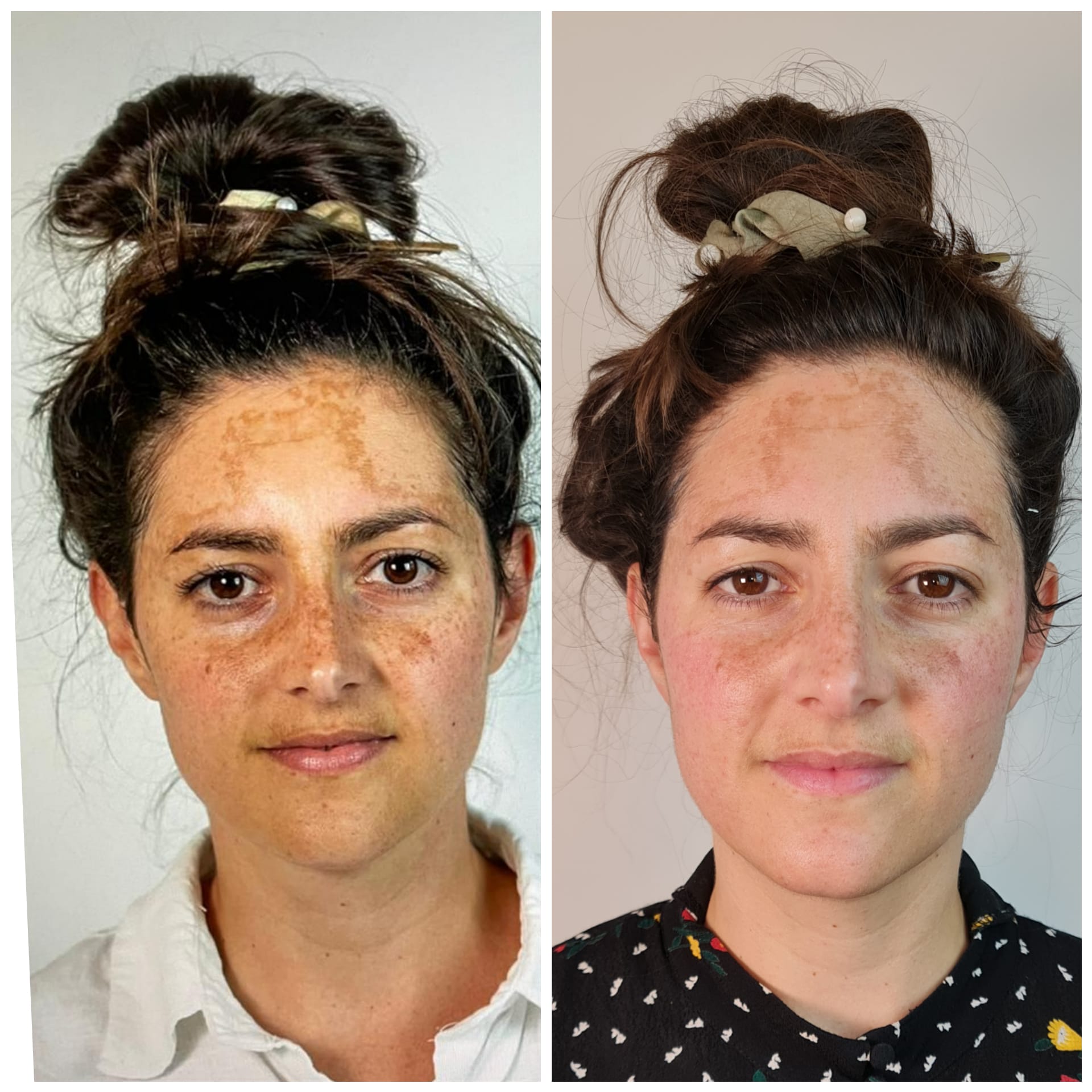 Skinstorm pigmentatie voor en na